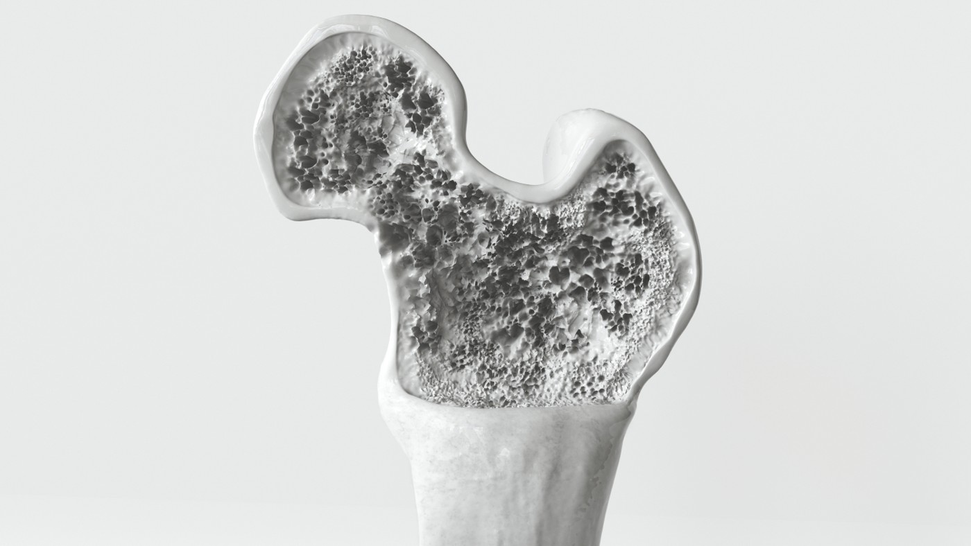 Illustration of bone density loss in the femoral head